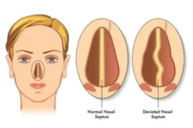 E-Point-to-Septum Separation : E 点到隔膜分离