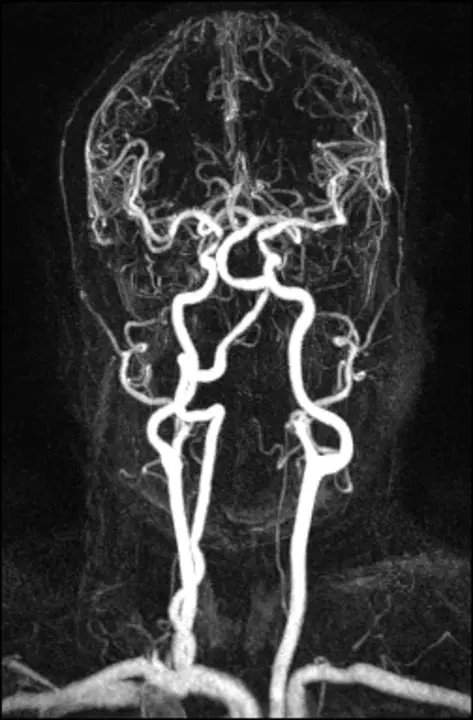 Vertebrobasilar dolichoectasia : 椎基底动脉延长扩张症