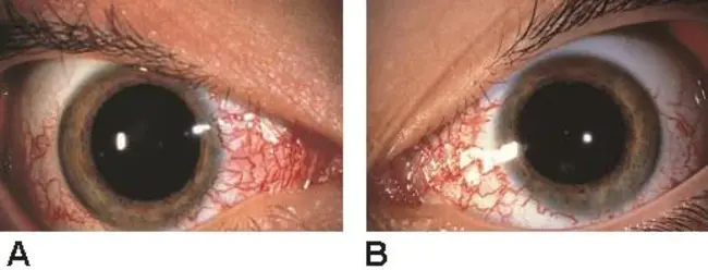 Ataxia Telangiectasia Mutated : 共济失调毛细血管扩张症突变