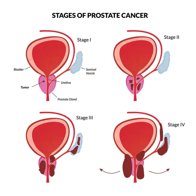 Prostate Cancer Index : 前列腺癌指数