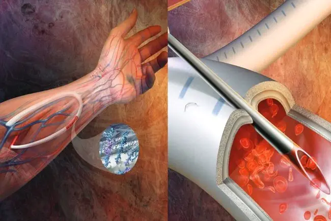 Vascularized Plantar Free Flap : 带血管的足底游离皮瓣