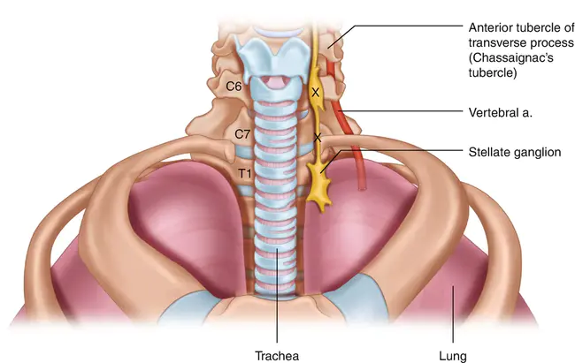 Stellate Ganglion Block : 星状神经节阻滞