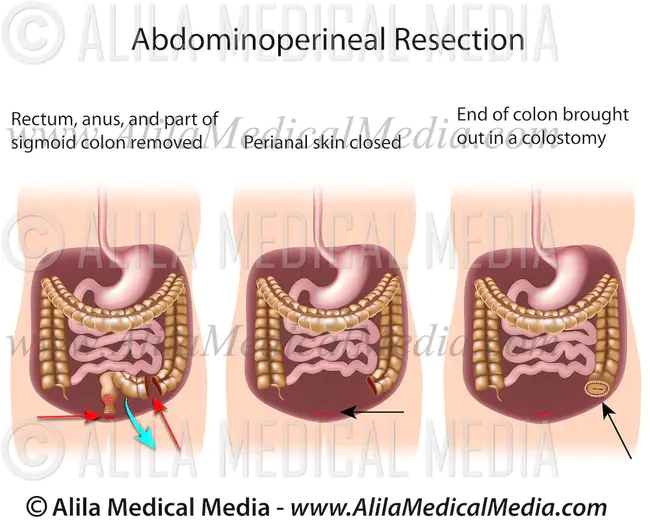 abdominoperineal resection : 腹会阴切除术
