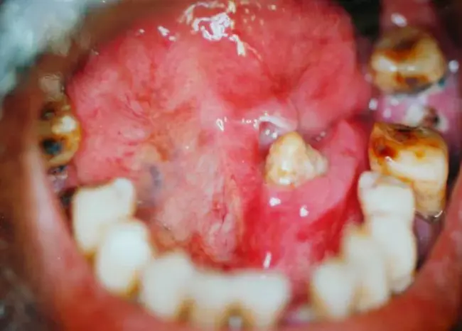 Salivary Alpha Amylase : 唾液α淀粉酶