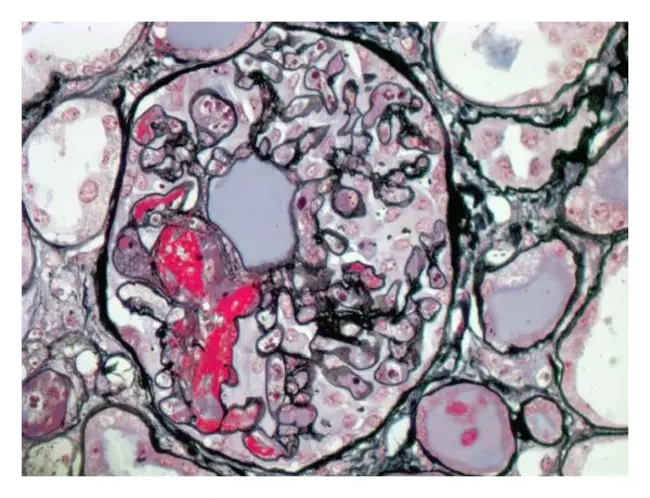 Disseminated Sclerosis : 弥散性硬化