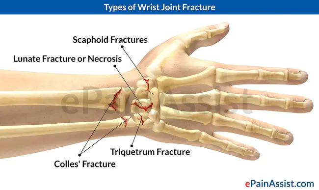 Wrist Disarticulation : 腕关节脱位