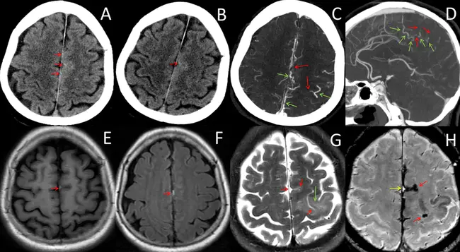 Thrombolysis in Cerebral Infarction : 脑梗死溶栓