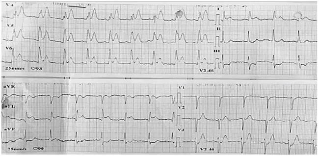 non-ST-segment elevation myocardial infarction : 非ST段抬高型心肌梗死