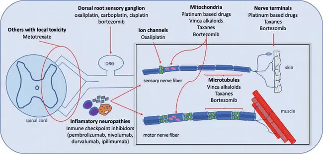 Chemotherapy-Induced Peripheral Neuropathy : 化疗诱导的周围神经病变