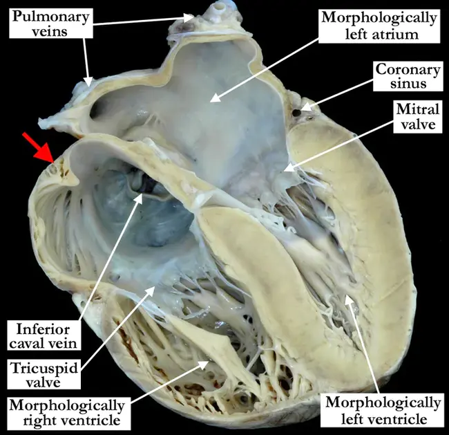 atrioventricular nodal reentrant tachycardia : 房室结折返性心动过速