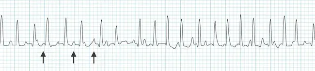 Multifocal Atrial Tachycardia : 多灶性房性心动过速