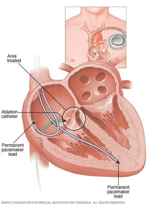 atrioventricular node : 房室结