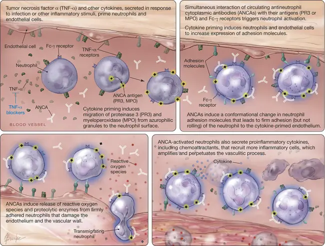 antineutrophil cytoplasmic antibody : 抗中性粒细胞胞质抗体