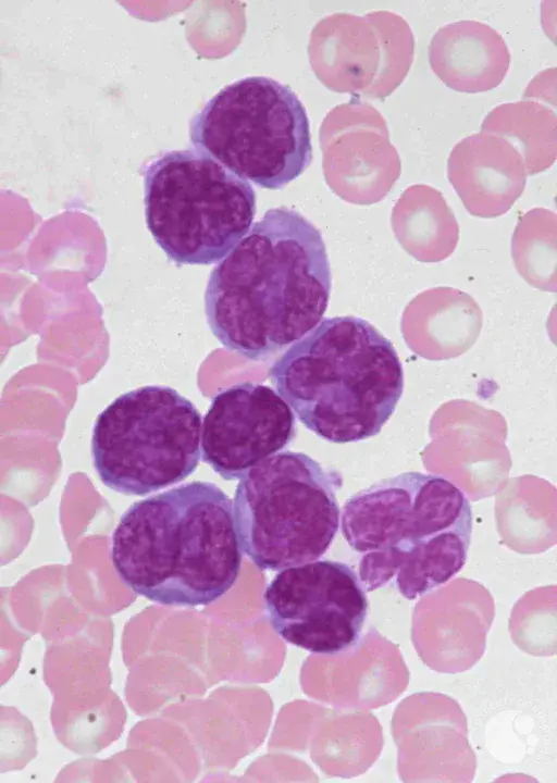 T-cell-leukemia-lymphoma : T细胞白血病淋巴瘤