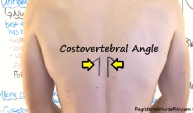 Costovertebral Angle Tenderness : 肋椎角压痛