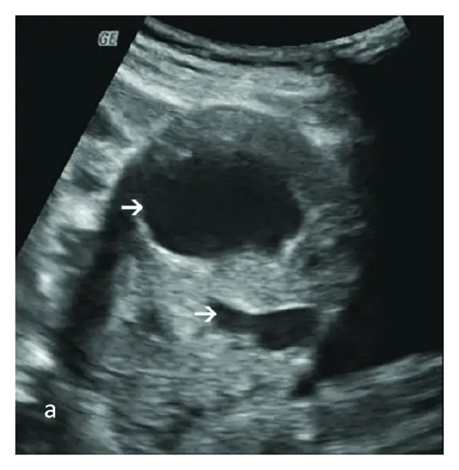 Gestational Trophoblastic Disease : 妊娠滋养细胞疾病
