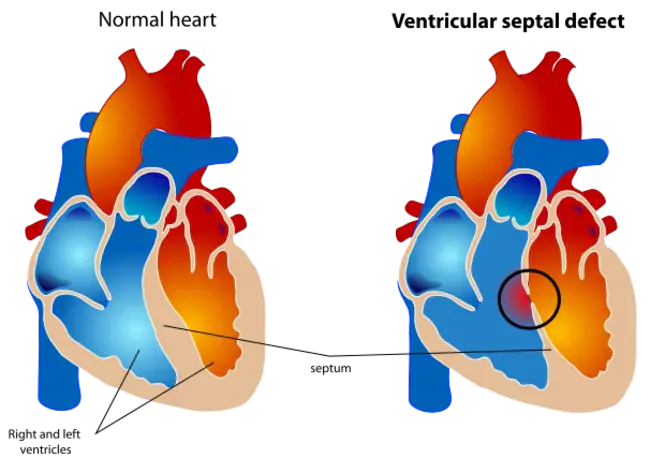 Ventricular Mass Index : 心室质量指数