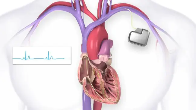 Cardiac Implantable Electronic Device/Pacemaker : 心脏植入式电子设备/起搏器