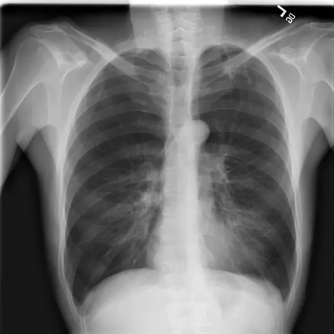 Chest Computed Tomography : 胸部计算机断层扫描