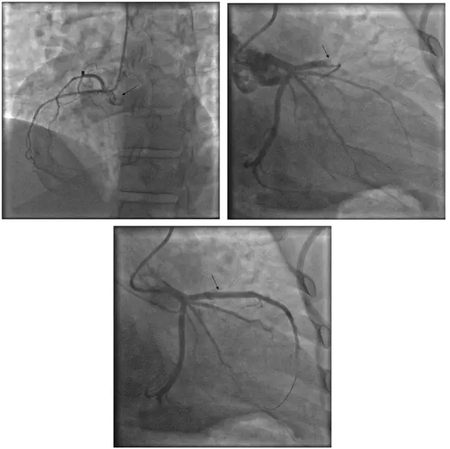 Occluded Artery Trial : 闭塞动脉试验