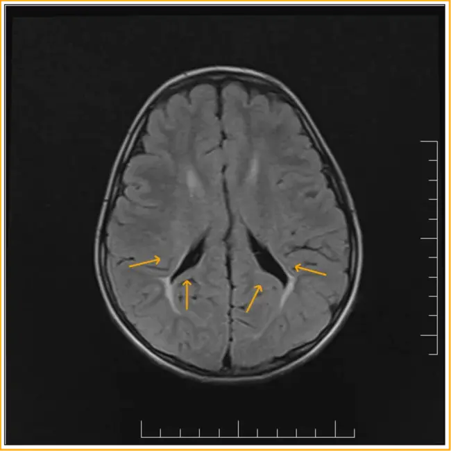 periventricular nucleus : 室周核