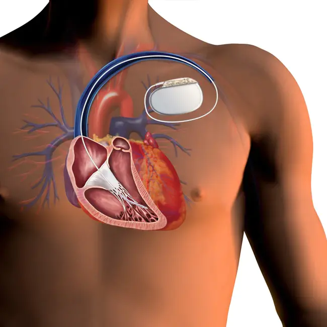implantable cardioverter–defibrillator : 植入式心脏复律除颤器