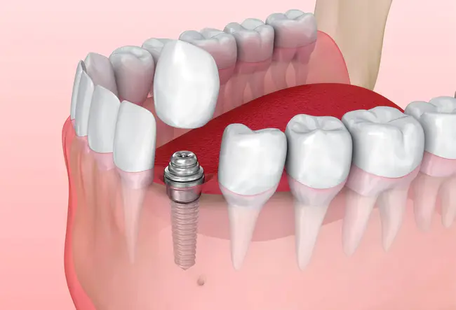 Dental Hygeinist : 牙科卫生员