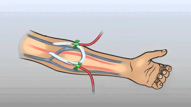 ArterioVenous Graft : 动静脉移植