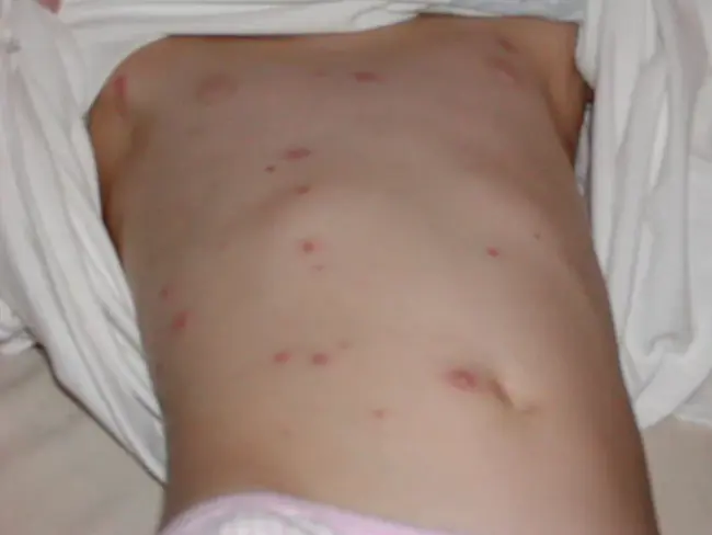 Varicella Vaccine : 水痘疫苗