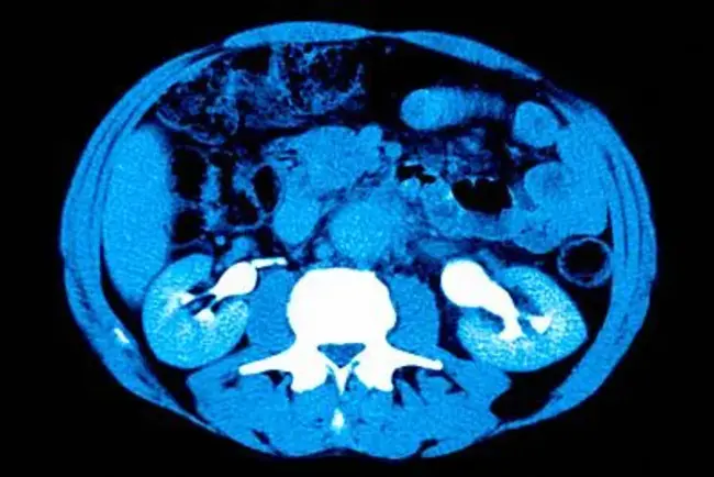 Kidney Ureter Bladder : 肾输尿管膀胱