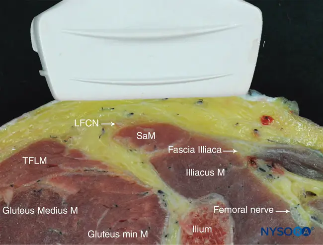 Femoral Head Osteotomy : 股骨头截骨术