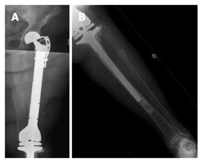 Femoral Actetabular Impingement : 股骨髋臼撞击