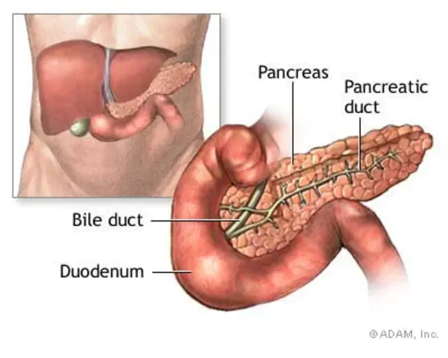 Pancreatitis Associated Ascitic Fluid : 胰腺炎相关腹水