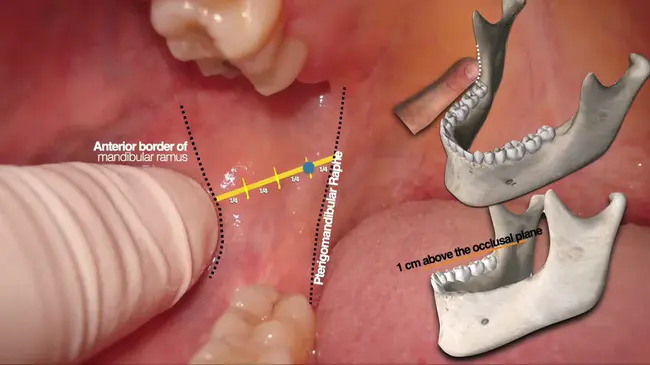 Inferior Alveolar Nerve Block : 下牙槽神经阻滞