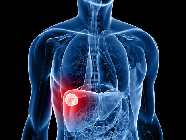 Metastatic Medulary Thyroid Carcinoma : 甲状腺转移性药物瘤