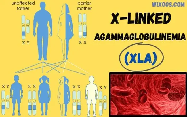 X Linked Agammaglobulinemia : X-连锁无丙种球蛋白血症