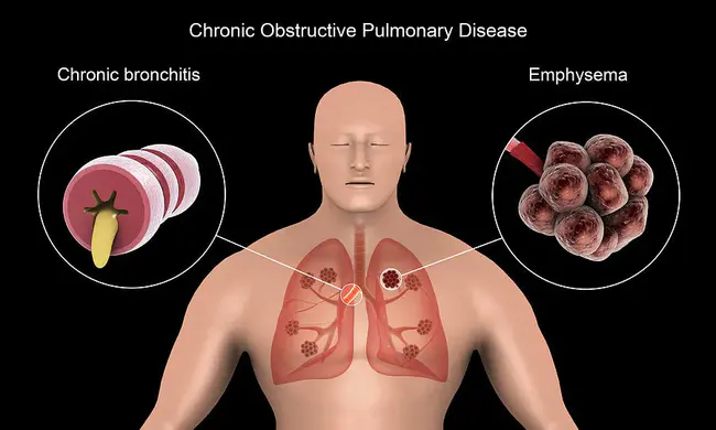 Chronic Lymphocytic : 慢性淋巴细胞性