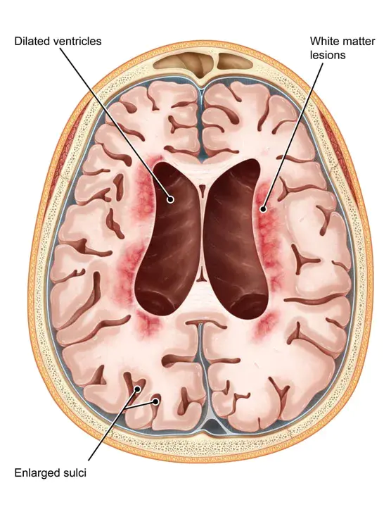 Neuronal Ceroid Lipofuscin : 神经元蜡质脂褐质