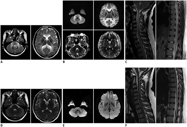 Chronic Traumic Encephalopathy : 慢性外伤性脑病