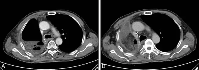 Transverse Rectus Abdominis Myocutaneous : 腹横直肌肌