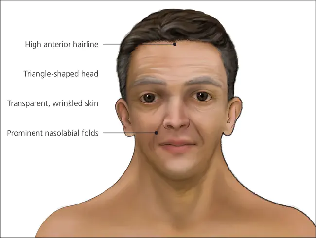 Empty Nose Syndrome : 空鼻综合征