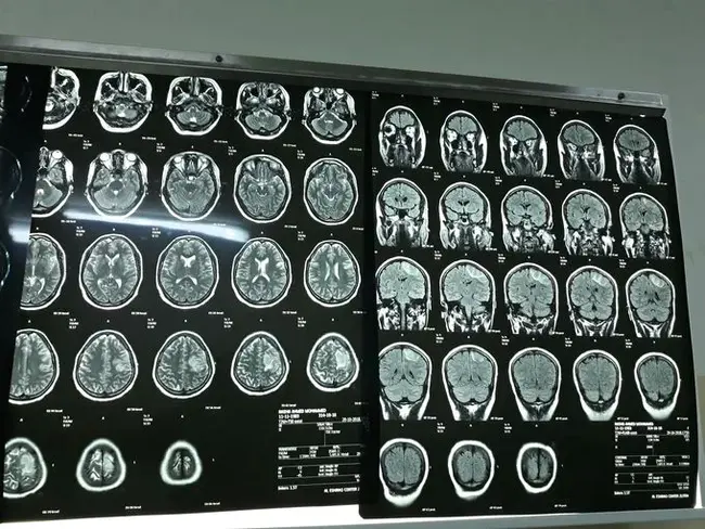 Mechanical Diagnosis and Therapy : 机械诊断与治疗