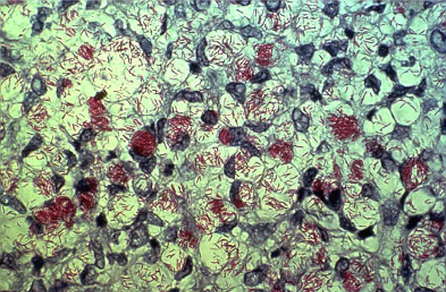 Leprosy Gonorrhoea Bacteria and Tuberculosis : 麻风淋病细菌和肺结核