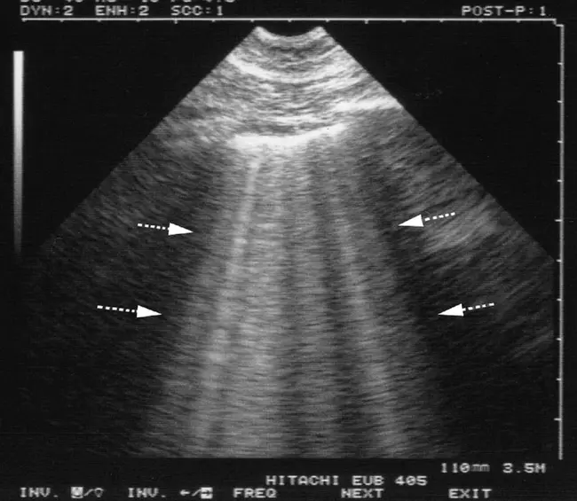 Lung Sparing Total Pleurectomy : 保肺全胸膜切除术