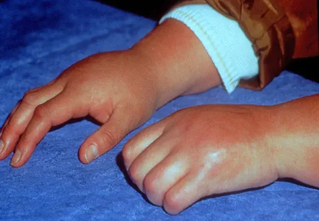 Juvenile rheumatoid : 幼年类风湿