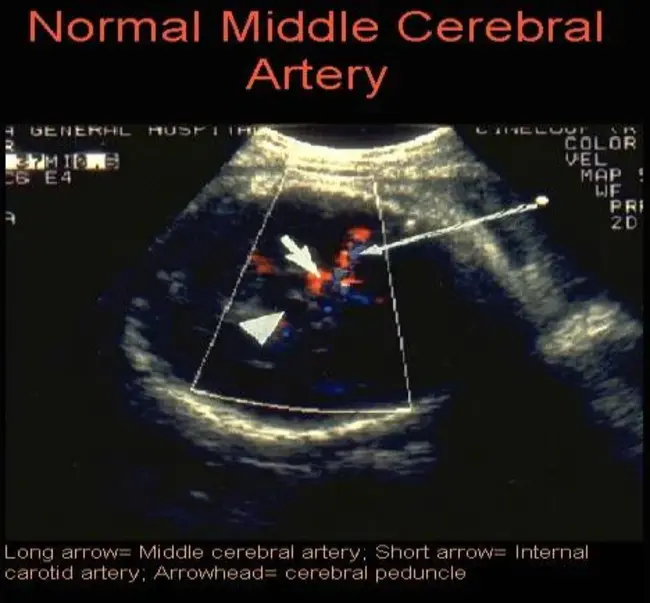 Anterior inferior cerebellar artery : 小脑前下动脉