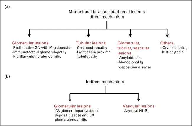 Monoclonal Gammopathy of Renal Significance : 肾脏意义的单克隆性丙种球蛋白病