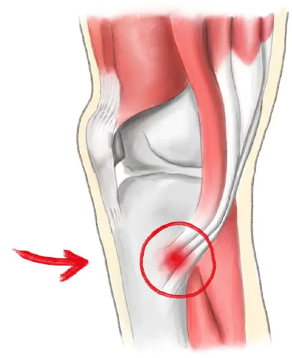 Pes Anserinus Tendino Bursitis : 鹅足腱滑囊炎