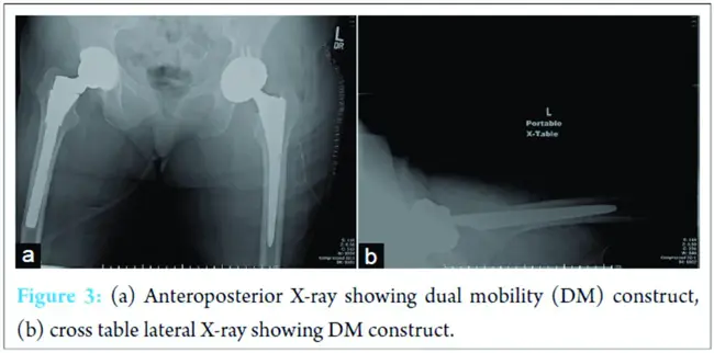 Study of Osteoporotic Fractures : 骨质疏松性骨折的研究