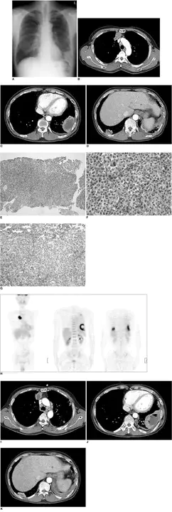 High Resolution Chest Tomography : 高分辨率胸部断层扫描